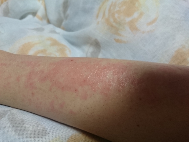 マダニの被害にあった場合